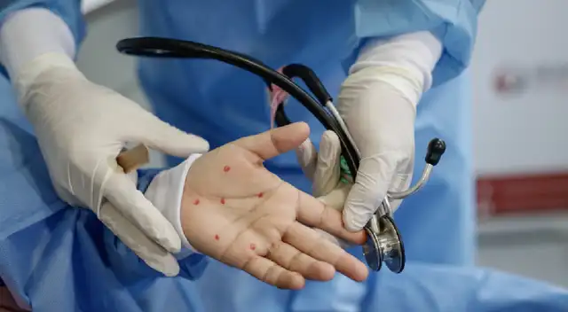 Viruela del mono: se eleva a 157 los casos confirmados en el Perú