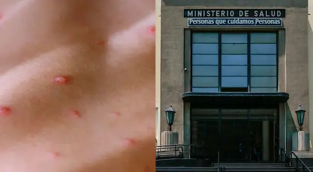 Viruela del mono en Perú: casos aumentan a 183 en el país, confirma el Minsa