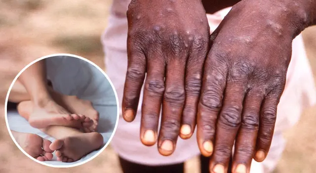 El INS recomendó a la población reducir el número de parejas sexuales, además de evitar el sexo casual, ya que el preservativo no ayuda a evadir el contagio del Monkeypox. El INS recomendó a la población reducir el número de parejas sexuales, además de evitar el sexo casual, ya que el preservativo no ayuda a evadir el contagio del Monkeypox.