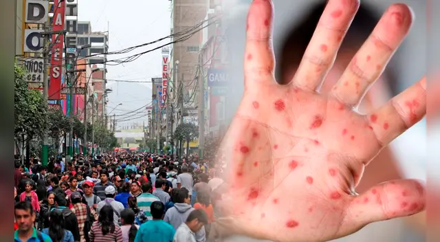 viruela del mono se estaría saliendo de control