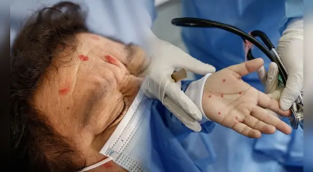 Brasil confirma la primera muerte por viruela del mono y enciende las alarmas en todo el planeta.