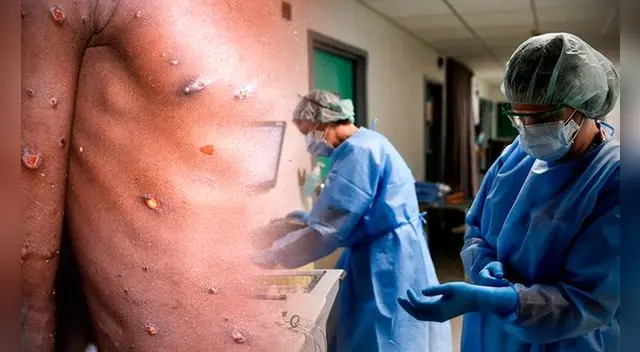 Los casos de viruela del mono en el mundo continúan en ascenso y preocupan a los sanitarios. Foto: composición/EFE/AFP Los casos de viruela del mono en el mundo continúan en ascenso y preocupan a los sanitarios. Foto: composición/EFE/AFP