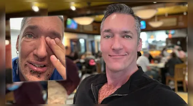 ¿Qué dijo el paciente sobre los síntomas que padece tras infectarse de la viruela del mono? ¿Qué dijo el paciente sobre los síntomas que padece tras infectarse de la viruela del mono?