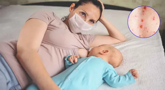 La OMS ha declarado a la viruela del mono como emergencia internacional a fin de extremar los cuidados sanitarios.