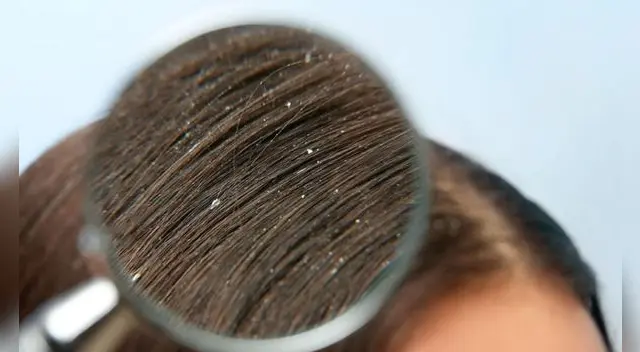 Uno de los problemas que las personas presentan en el cuero cabelludo es la caspa. Uno de los problemas que las personas presentan en el cuero cabelludo es la caspa.