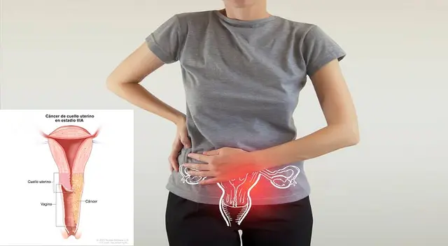 Los chequeos preventivos son vitales para no desarrollar el cáncer de cuello uterino.