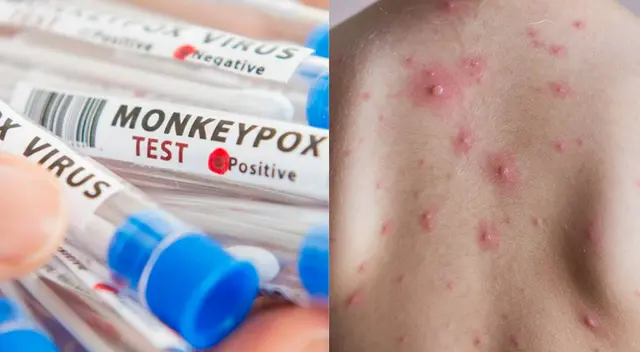 Ambas se caracterizan por causar erupciones en la piel.