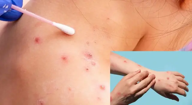 Sepa cómo puede contagiarse de la viruela del mono y tenga cuidado. Sepa cómo puede contagiarse de la viruela del mono y tenga cuidado.