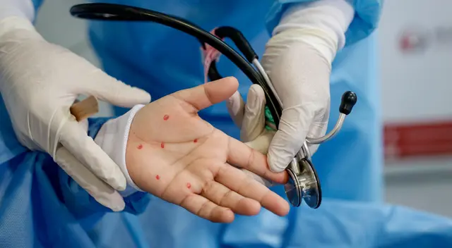 El Minsa mencionó que por lo menos tres países están interesados en adquirir el medicamento contra esta enfermedad. El Minsa mencionó que por lo menos tres países están interesados en adquirir el medicamento contra esta enfermedad.