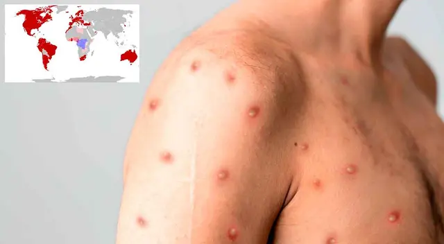 Conoce en qué países se han reportado más casos de viruela del mono.