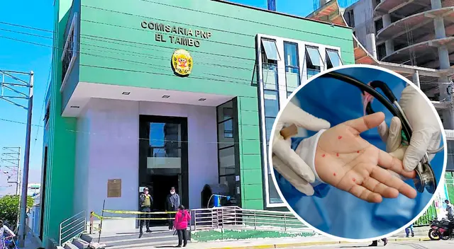 Producto de las diligencias, algunos agentes policiales también se habrían contagiado de la viruela del mono. Producto de las diligencias, algunos agentes policiales también se habrían contagiado de la viruela del mono.