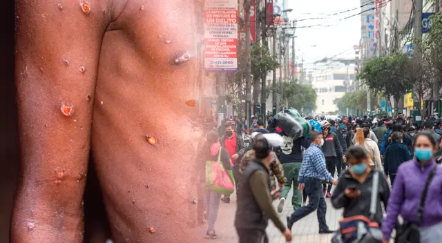 viruela del mono viruela del mono