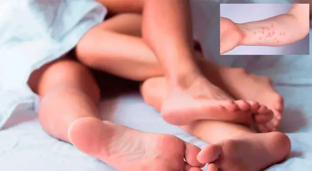 La causa más probable de transmisión de la viruela del mono es el contacto piel con piel durante las relaciones sexuales.