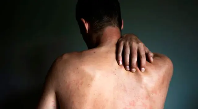 Viruela del mono en Perú: el triste relato de un paciente tras contraer monkeypox: “Son dolores muy fuertes”