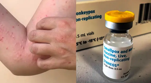 Viruela del mono en Perú: vacunas llegarían al país a inicios de septiembre, indicó la OPS Viruela del mono en Perú: vacunas llegarían al país a inicios de septiembre, indicó la OPS