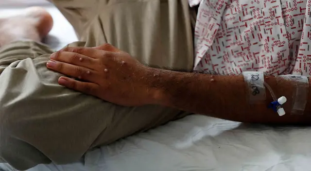 Casos de contagio por este mal está en crecida en el país. Casos de contagio por este mal está en crecida en el país.