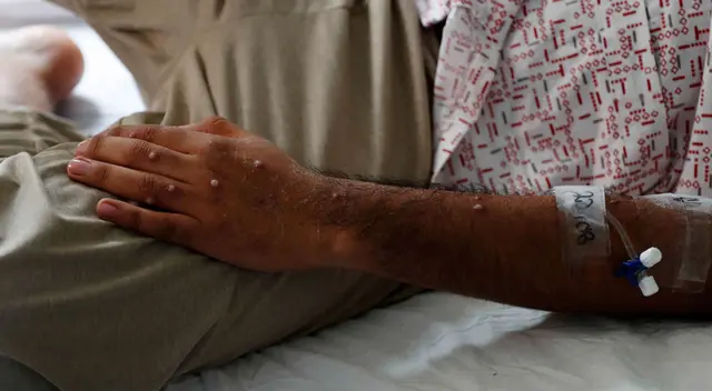 Perú es el séptimo país que cuenta con más pacientes con la viruela del mono en el Mundo. Perú es el séptimo país que cuenta con más pacientes con la viruela del mono en el Mundo.