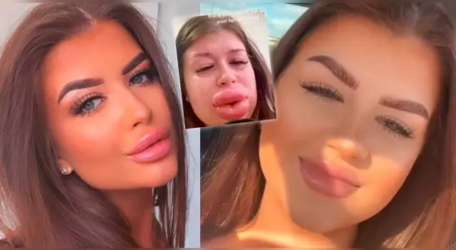 La joven se encuentra en recuperación tras inesperado resultado estético. La joven se encuentra en recuperación tras inesperado resultado estético.