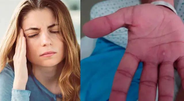 Uno de los transtornos neurológicos que produce la viruela del mono en las personas es la encefalitis.