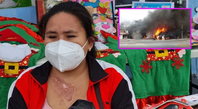 Mamita afectada por quemaduras producto de la deflagración de gas en el 2020 Mamita afectada por quemaduras producto de la deflagración de gas en el 2020