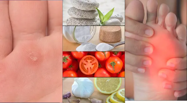 Remedios para eliminar los callos