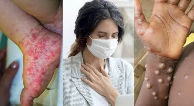 Conoce aquí como diferenciar los síntomas de la Gripe del tomate, Covid-19, Viruela del mono