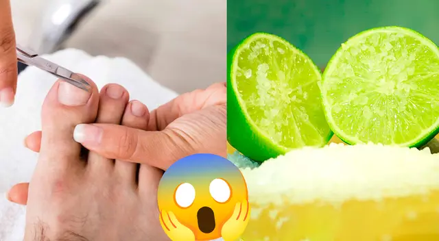 Descubre aquí un par de métodos caseros para sacar los uñeros sin dolor