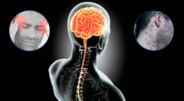 Conoce por qué la viruela del mono podría causar problemas en el Sistema Nervioso Central. Conoce por qué la viruela del mono podría causar problemas en el Sistema Nervioso Central.