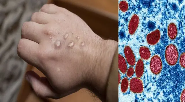 La viruela del mono se sigue propagando por el mundo. La viruela del mono se sigue propagando por el mundo.