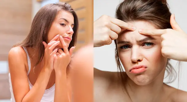 Conoce remedios para eliminar el acné. Conoce remedios para eliminar el acné.