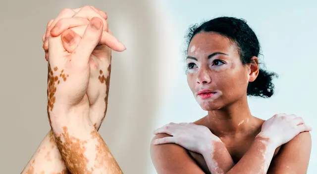 Conoce detalles sobre el vitíligo, qué lo causa y cómo tratarlo.