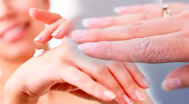 Conoce cómo tratar que las manos y las yemas de los dedos se pelen.