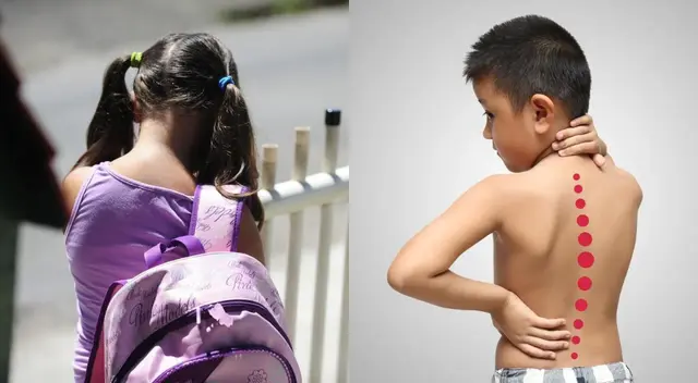 Los pacientes con escoliosis deben tener un seguimiento y tratamiento fisioterapeútico.