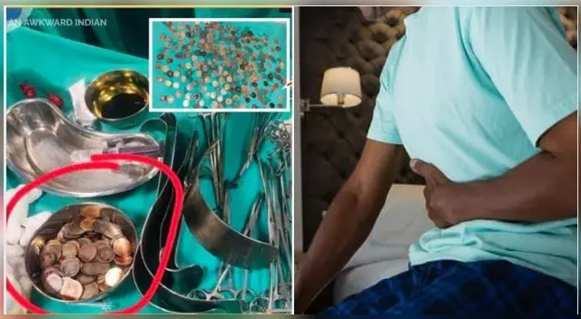 Daymappa Harijan, de 58 años, ingirió 187 monedas y sus familiares no se dieron cuenta en la India. Daymappa Harijan, de 58 años, ingirió 187 monedas y sus familiares no se dieron cuenta en la India.