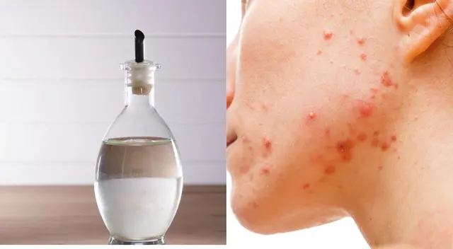 El vinagre de manzana es rico en polifenoles, los cuales tiene propiedades antibacterianas, antifúngicas y desinfectantes. El vinagre de manzana es rico en polifenoles, los cuales tiene propiedades antibacterianas, antifúngicas y desinfectantes.