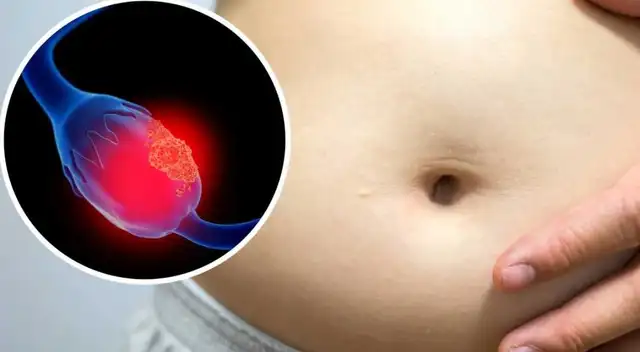El cáncer de ovario afecta a un gran porcentaje de mujeres a nivel mundial.