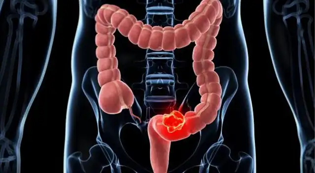 El cáncer de colon es una enfermedad que puede atacar a cualquier persona sin importar la edad.