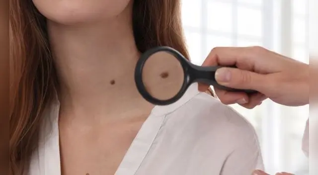La importancia de identificar un lunar y prevenir el cáncer de piel. La importancia de identificar un lunar y prevenir el cáncer de piel.