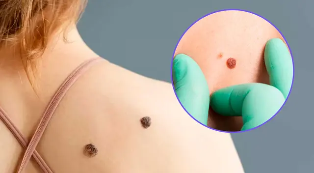 Conoce detalles sobre el cáncer de piel.