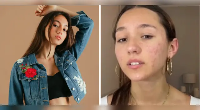 Alexia Barnechea muestra su acné.