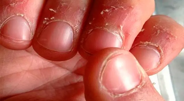 Conoce por qué se pelan la manos. Conoce por qué se pelan la manos.