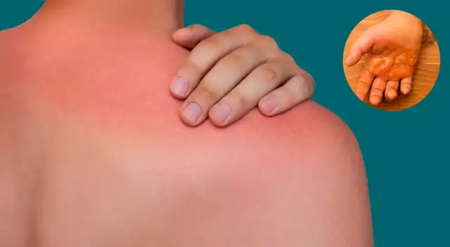 ¿Existen quemaduras en la piel ante una ola de calor?