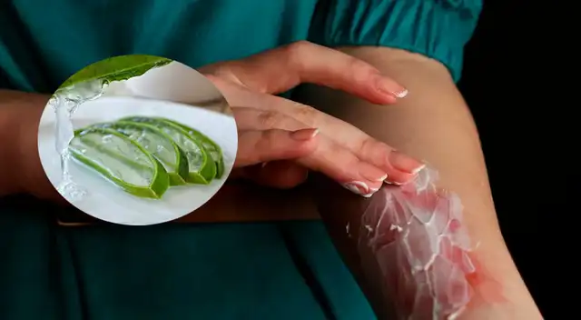 Conoce las 5 mejores cremas caseras para evitar una quemadura en la piel