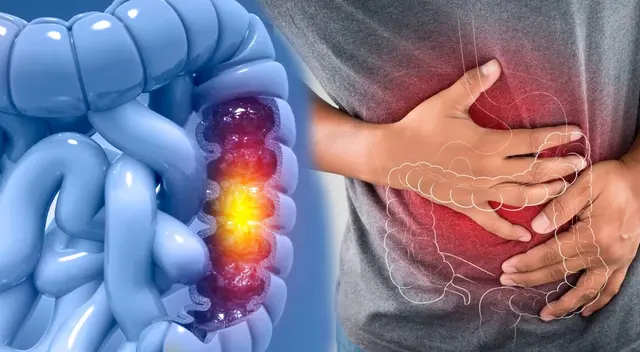 Conoce qué señales podrían indicar que tendrías cáncer de colon.