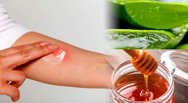 ¿Cuál son los mejores remedios caseros para aliviar las quemaduras?