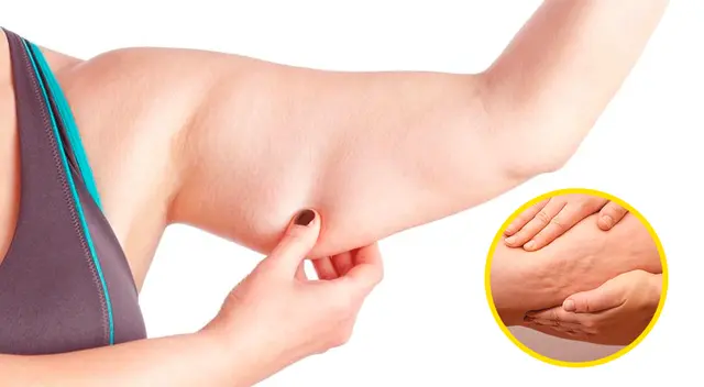 La celulitis es conocida también como "piel naranja" una afección contra la piel.