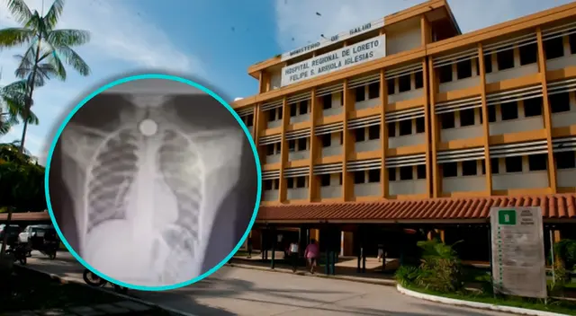 Niña se tragó una moneda de 1 sol en Loreto y su estado de salud es delicado.