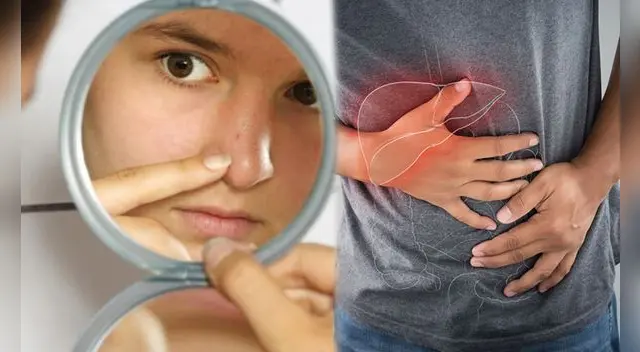 El hígado graso es una afección en la cual se acumula grasa en las células del hígado.