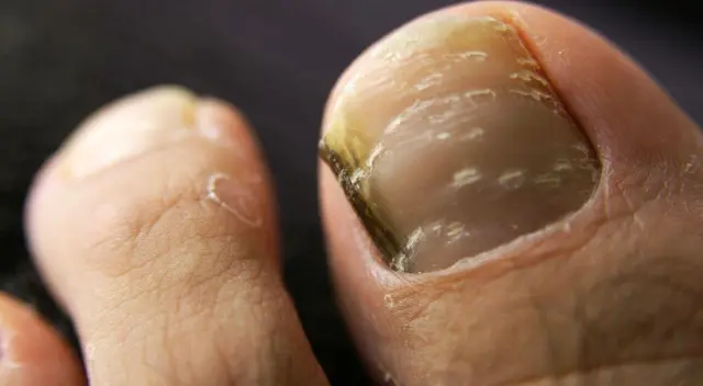 Los hongos en las uñas de los pies pueden presentar tonalidades amarillentas, marrones o blancas.