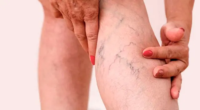 ¿Cansado de las varices? Estos remedios caseros te ayudarán
